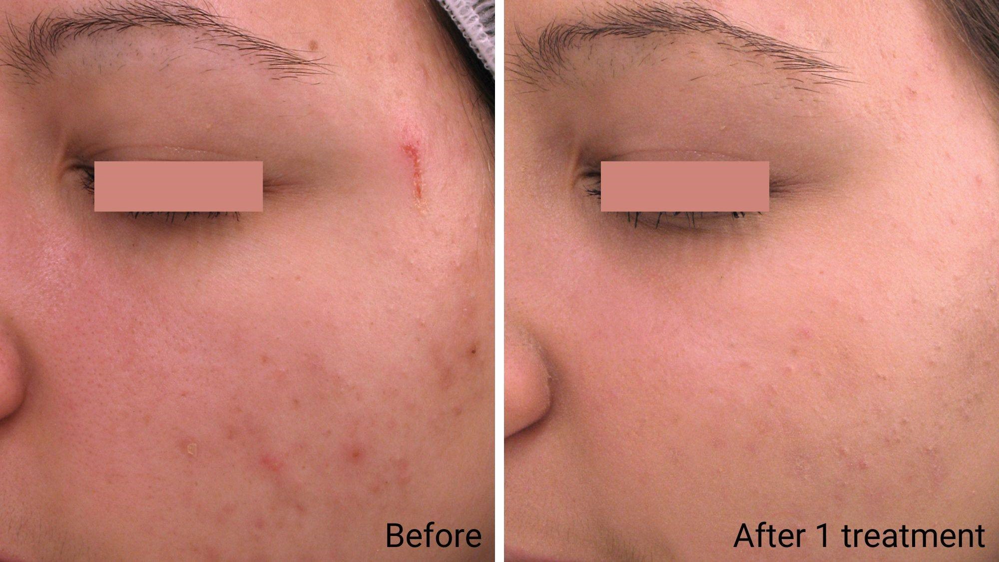 Before and after results