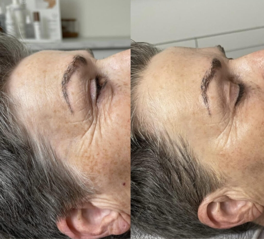Before and after Botinol Expression Line Facial results