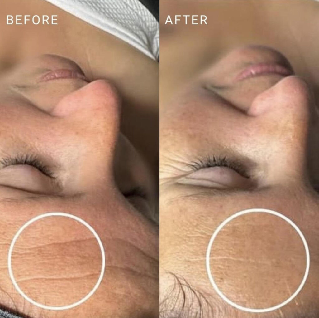 Before and after results