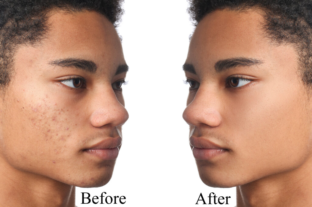 African-American teenage boy before and after acne treatment on white background
