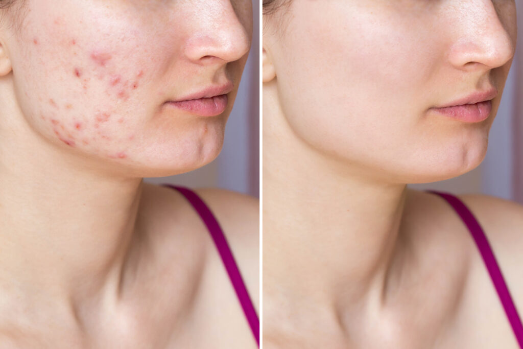 Before and after results