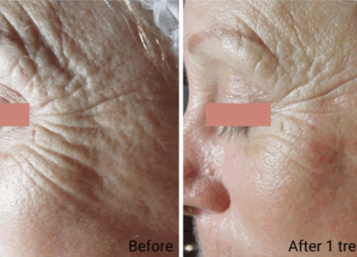 Botinol Expression Line Facial at Lashiqué