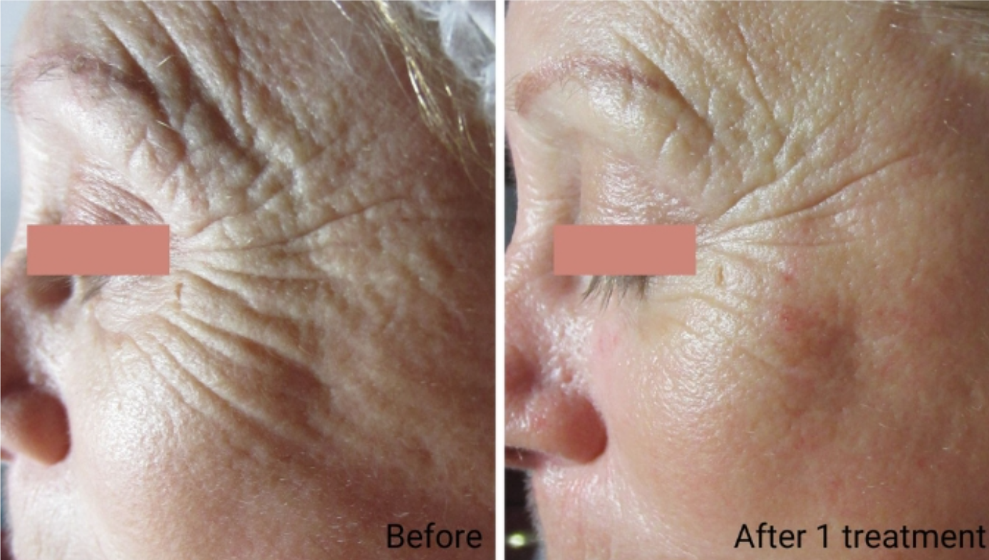 Transform Your Skin with Botinol Expression Line Facial | Age-Defying Treatment at Lashiqué