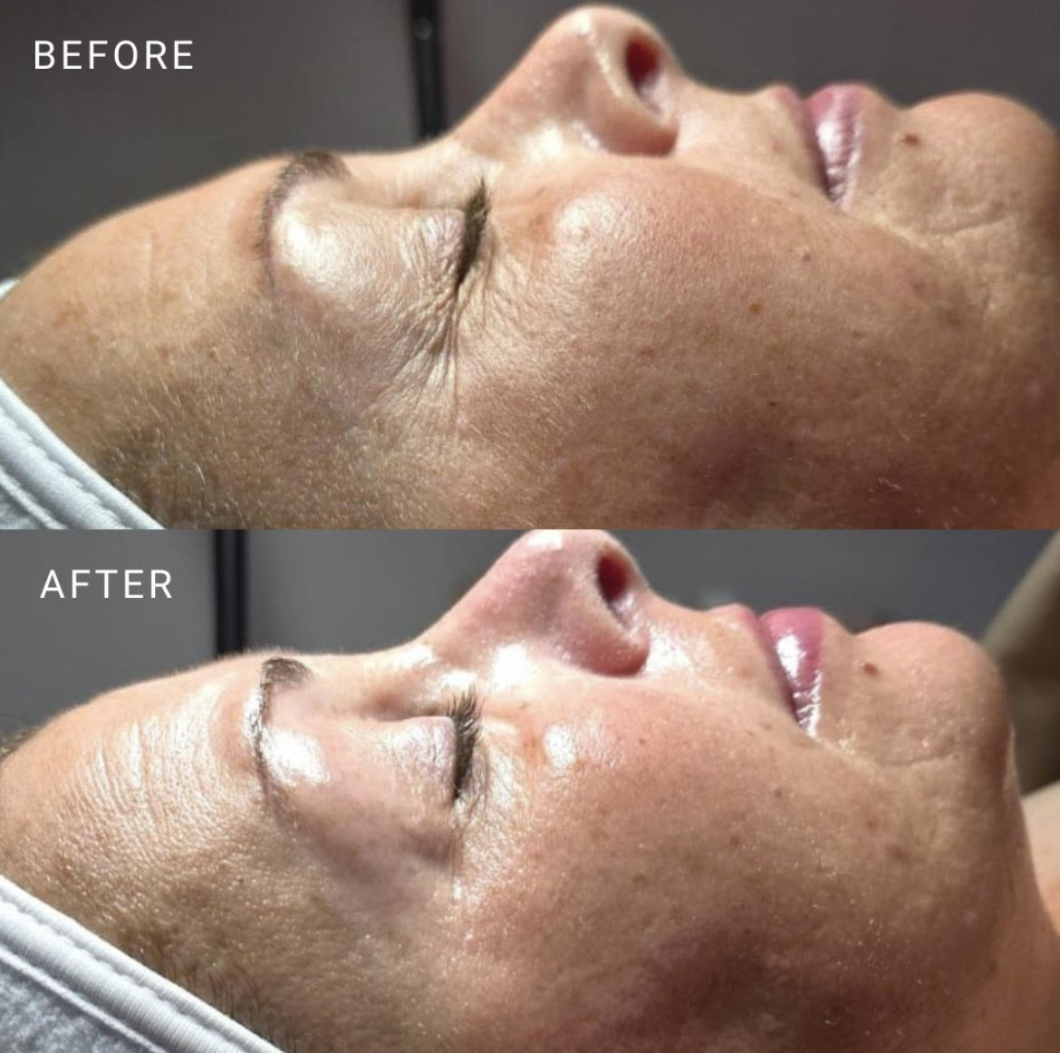 Lashiqué Signature Hydrolifting Facial: Instant Lift, Lasting Glow for Ageless Skin