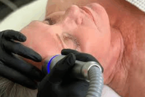 cooling therapy for skin tightening and anti-aging at Lashiqué Studios