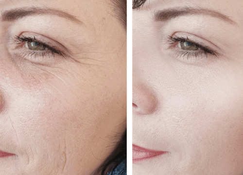 Before and after facial treatment showing improvement in wrinkles caused by sun damage and dehydration.