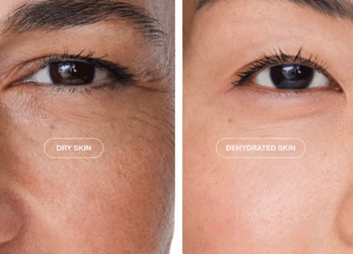 Close-up of facial skin highlighting dry vs dehydrated skin, comparing flaky dryness with dull, tight dehydration.