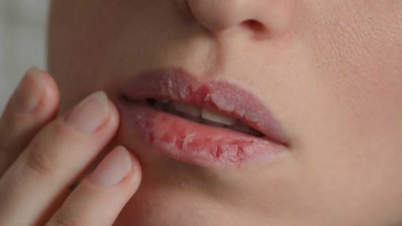 Chapped Lips in Winter: The Real Reasons Your Lips Get Crusty  And the Ultimate Way to Fix Them Fast