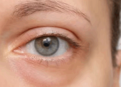 Close-up of under-eye circles and fine lines caused by winter dryness, dehydration, and reduced circulation.
