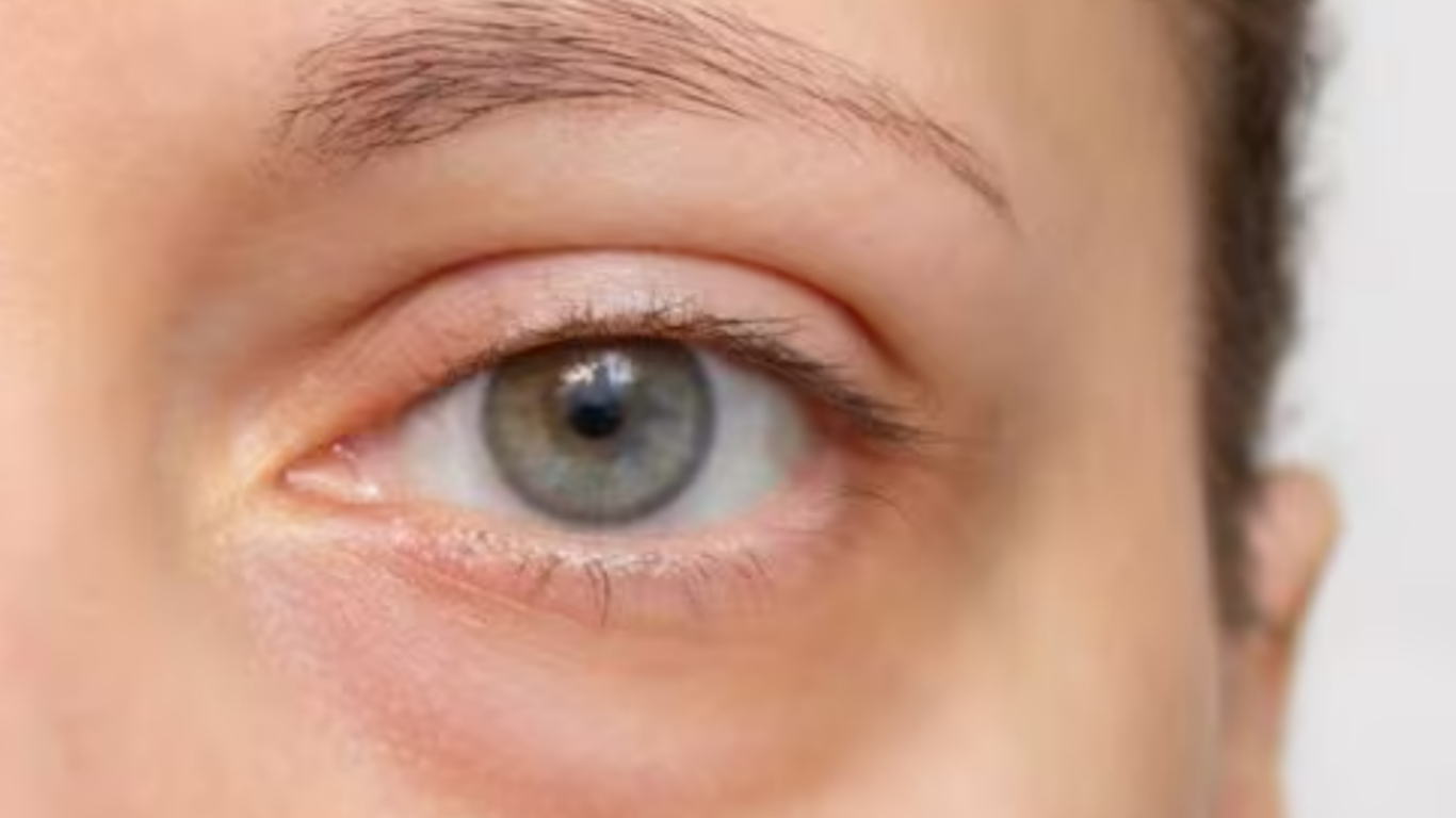 Under-Eye Circles Winter: The Surprising Reasons They Look Worse in December, And How to Brighten Them Fast